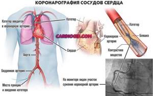 Коронарография сердца: что показывает и как ее делают, противопоказания и возможные последствия