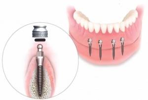 Протезирование зубов: виды зубных протезов и мостов, варианты съемных и несъемных, лучшие стоматологические протезы