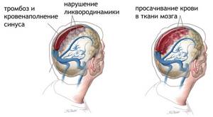 Тромбоз синусов головного мозга: причины, симптомы, лечение