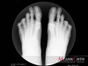 Болит сустав большого пальца на ноге: чем лечить и как, причины появления боли