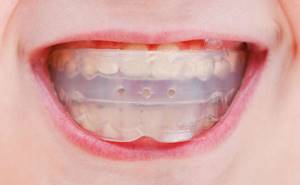 Детские и взрослые трейнеры для зубов: разновидности, показания, правила ношения, стоимость