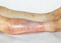 Облитерирующий атеросклероз сосудов нижних конечностей – симптомы и лечение