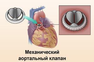 Замена клапана на сердце: жизнь после операции, стоимость и реабилитация