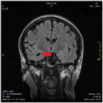 Хирургическое лечение эпилепсии (операция лобэктомия, имплантация нейростимулятора и другие)