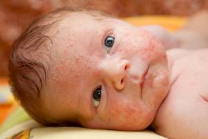 Как лечить потничку у новорожденных на теле (шея, лицо, спина, ноги)