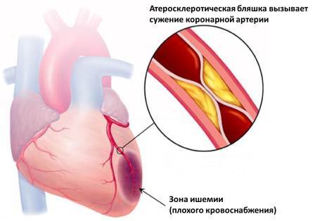 Ишемия сердца, ишемическая болезнь (ИБС): симптомы, лечение, формы, профилактика