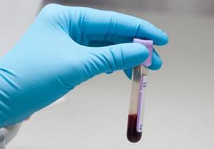 Повышенный билирубин в крови: причины и лечение
