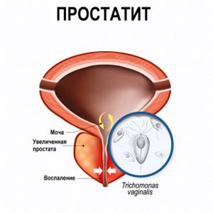 Трихомониаз инкубационный — Инкубационный период трихомониаза, симптомы