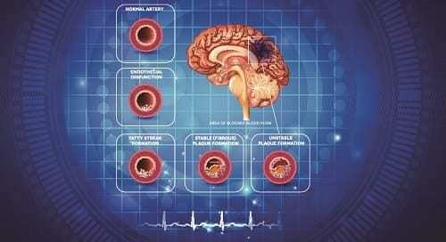 Дисциркуляторная энцефалопатия головного мозга — симптомы и лечение разных стадий болезни