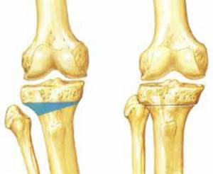 Корригирующая остеотомия: описание, особенности выполнения, возможные осложнения