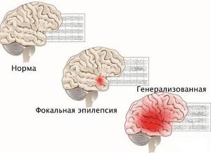 Эпилепсия: развитие, формы, причины, признаки и проявления, первая помощь, как лечить