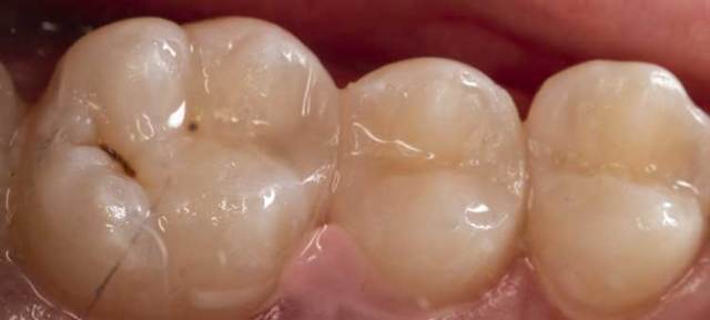 Световые пломбы для зубов из светоотверждаемого материала: что это, срок службы, как ставят