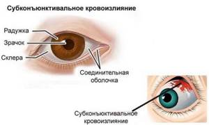 Кровоизлияние в глазу: причины и виды, методы лечения и прогноз сохранения зрения