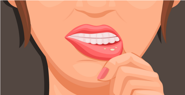 Жжение во рту и на языке: причины какой болезни, лечение. Почему печет губы, горло, небо, десны