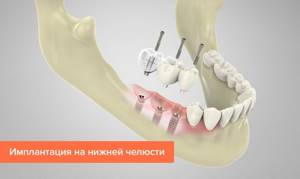 Зубные протезы при частичном отсутствии зубов: съемные и несъемные, виды, какие лучше, протезирование жевательных зубов