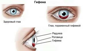 Кровоизлияние в глаз: виды и их отличие, причины, лечение, когда и чем опасно