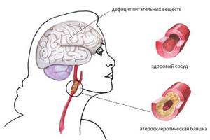 Резидуальная энцефалопатия: понятие, возникновение, симптомы, как лечить, прогноз