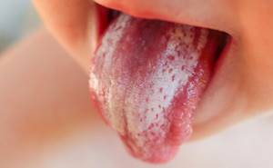 Красные и белые пупырышки и прыщики на языке у ребенка: причины появления, малиновый язык с пупырышками