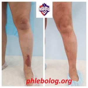 Красные пятна на ногах (фото): чем лечить и причины появления