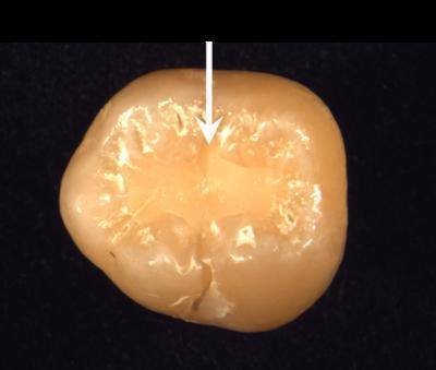 Световые пломбы для зубов из светоотверждаемого материала: что это, срок службы, как ставят