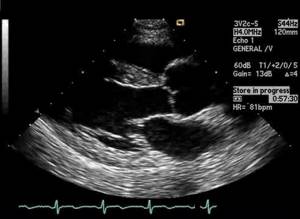 Расширение аорты (восходящей сердца, корня, брюшной): причины, лечение