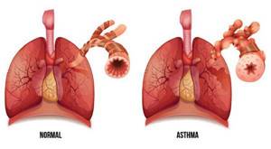 Бронхиальная астма: причины, симптомы и диагностика, лечение взрослых, классификация, профилактика и реабилитация, возможные осложнения, дают ли инвалидность