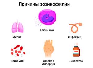 Эозинофилия: причины повышения эозинофилов в крови у взрослого, диагностика и лечение