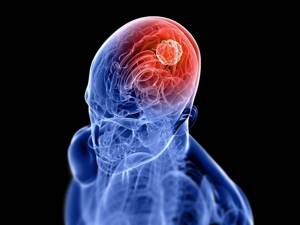 Опухоль головного мозга: обзор видов, симптомы и локализации, выявление, лечение