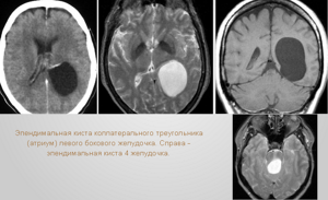 Киста прозрачной перегородки головного мозга (полость Верге): симптомы, лечение и последствия