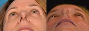 Искривление носовой перегородки код по МКБ-10 у взрослых: деформация и смещение носовой, синехии полости и наружного
