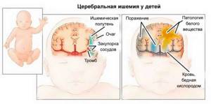 Церебральная ишемия 1 степени у новорожденного: 2 степени, головного мозга, последствия, что это такое