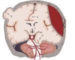 Дислокация головного мозга (дислокационный синдром): причины, последствия