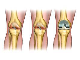 Эндопротезирование коленного сустава, цена и другие условия