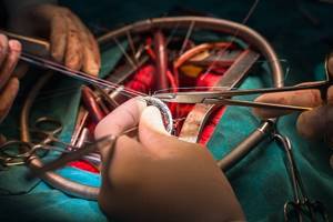 Протезирование клапанов сердца: митрального, аортального – операция, до и после