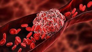 P-LCR (содержание крупных тромбоцитов в крови): что это, норма, когда повышается или понижается
