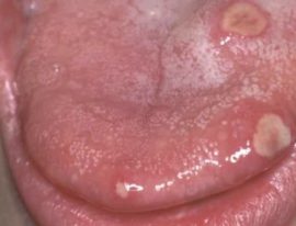 Что делать при ожоге языка: горячим кипятком, химическом - как лечить и снять боль