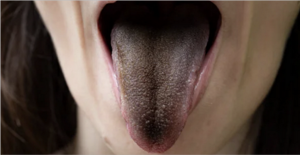 Черный язык у человека: взрослого причины, симптомы какого заболевания, что это значит, почему почернел язык