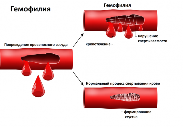 Агрегация тромбоцитов: что это такое, анализ крови, норма, отклонения