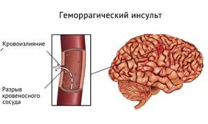 Субдуральная гематома (кровоизлияние) головного мозга: признаки, лечение, последствия