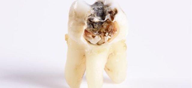 Гнилые зубы: последствия для организма, почему гниют зубы от десны под корень и что делать