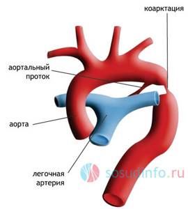 Коарктация аорты: что это, причины, симптомы в зависимости от стадии, лечение и прогноз жизни
