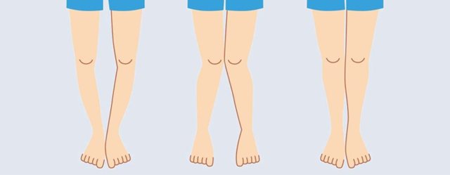 Варусная деформация стопы и ног у детей: причины, профилактика, лечение