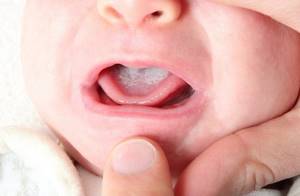 Белый налет на языке у грудничков и новорожденных: почему появляется, как лечить и чистить, фото