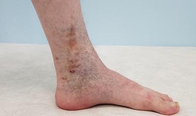 Красные пятна на ногах (фото): чем лечить и причины появления