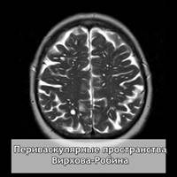 Функции и болезни мозолистого тела: агенезия, гипоплазия, дисплазия (дисгенезия)