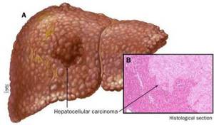 Лечение жирового гепатоза печени, можно ли вылечить