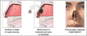 Искривление носовой перегородки код по МКБ-10 у взрослых: деформация и смещение носовой, синехии полости и наружного