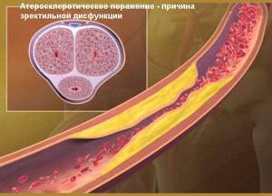 Вены на половых органах у мужчин: норма и патология, варикоз, воспаление