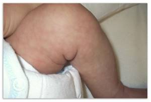 Мраморная болезнь у детей: кожа у грудничка, причины мраморности кожи, что это такое, при температуре