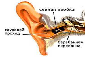 Можно ли капать перекись водорода в ухо, как капать правильно